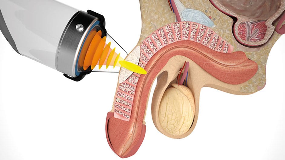 Terapia de onda de choque na doença de Peyronie