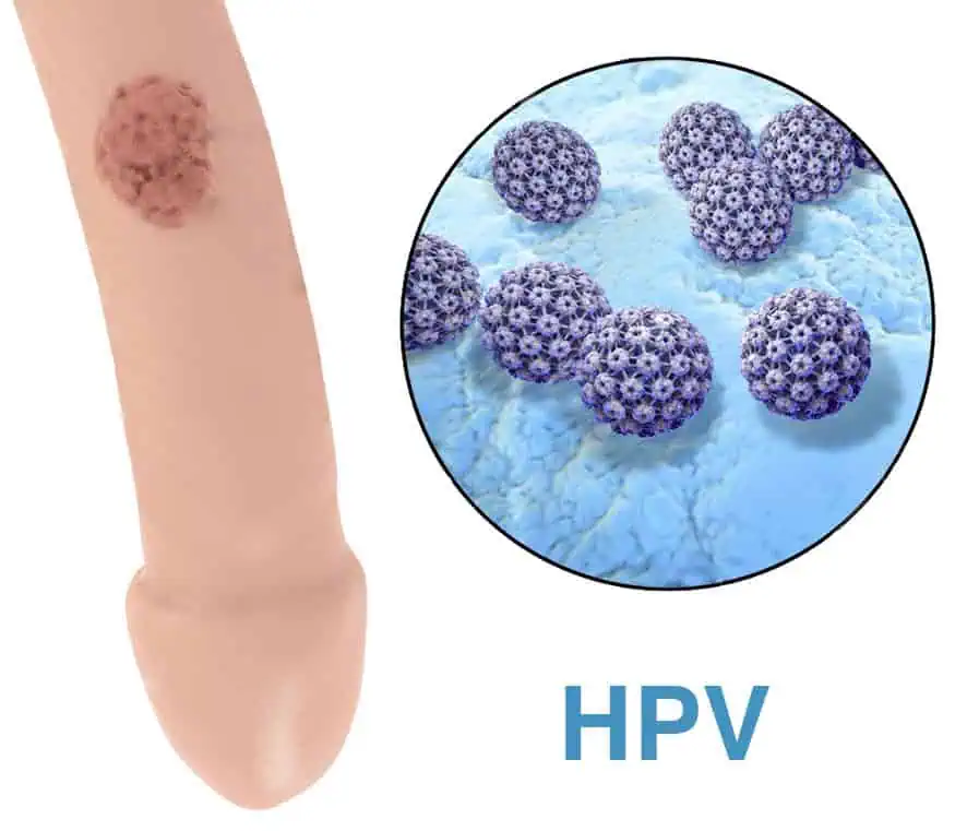 Common locations of genital warts in men